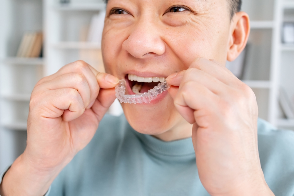 Dental care. Smiling man with healthy teeth using removable clear braces aligner, orthodontic silicone trainer